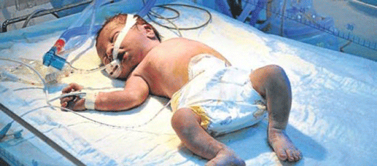 Bebeklerde Kasık Fıtığı Ameliyatı