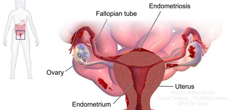 Endometriozis