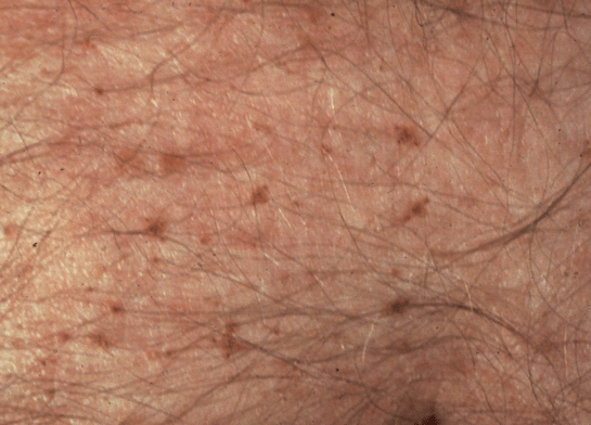 Kasık Biti Belirtileri ve Tedavisi